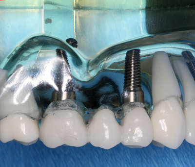 Металлокерамика в стоматологии