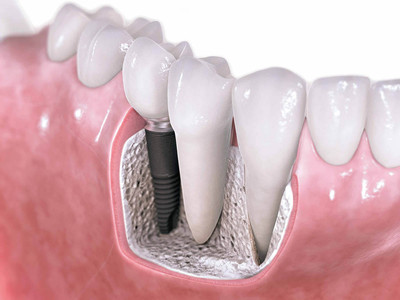 Протезы зубов и их превосходство