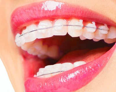 Сапфировые брекеты: а вы позаботились о красоте ваших зубов?
